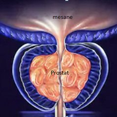 Benign Prostat Hiperplazisi (BPH) - Prof.Dr. Hakan 